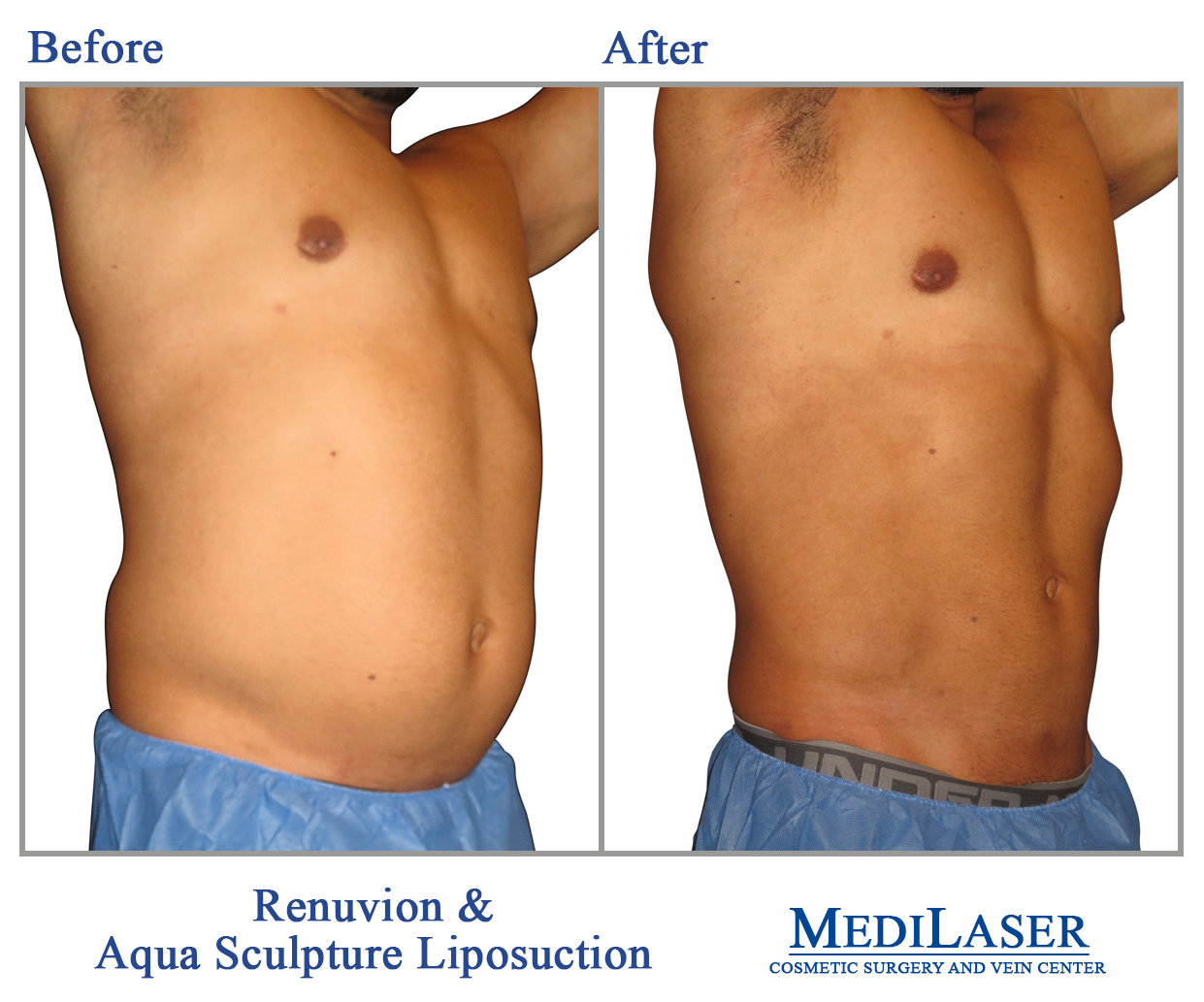 Liposuction Before And After Medilaser Surgery And Vein Center