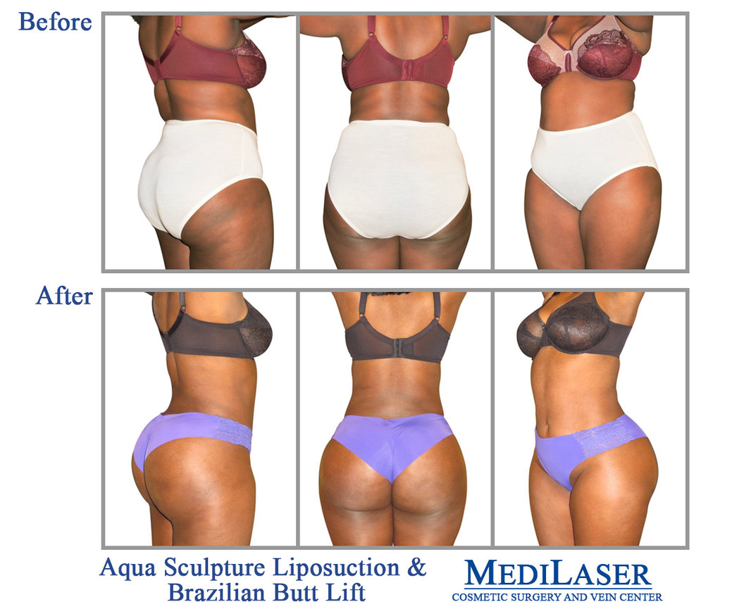 Brazilian-Butt-Lift-BBL-Before-After - Medilaser Surgery and Vein