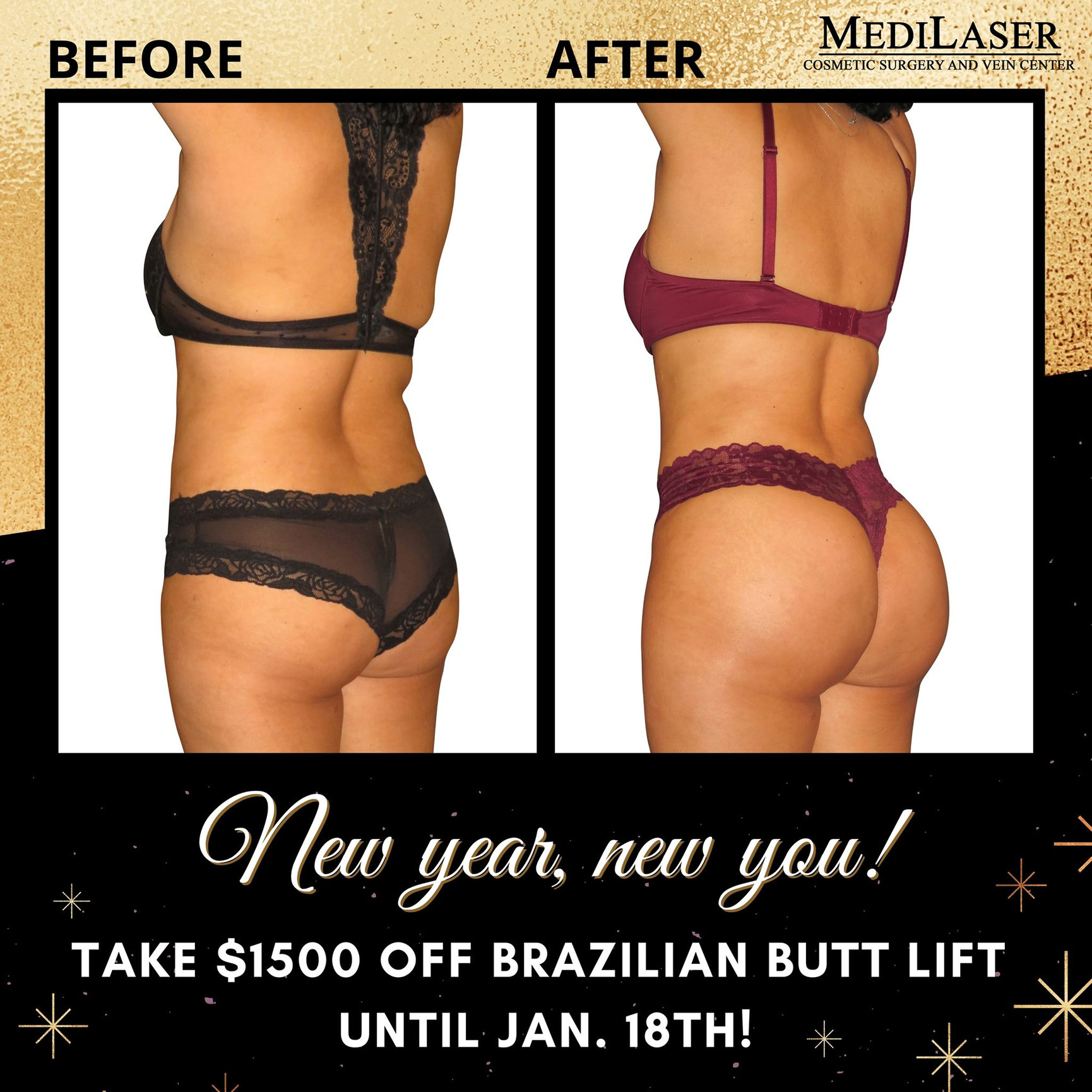 Brazilian Butt Lift Before And After - Medilaser Surgery and Vein