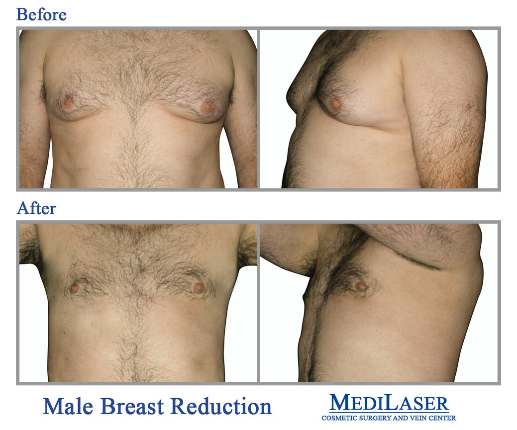 Rejuvaline Medspa - Gynecomastia surgery reduces breast size in men,  flattening and enhancing the chest contours. In severe cases of  gynecomastia, the weight of excess breast tissue may cause the breasts to