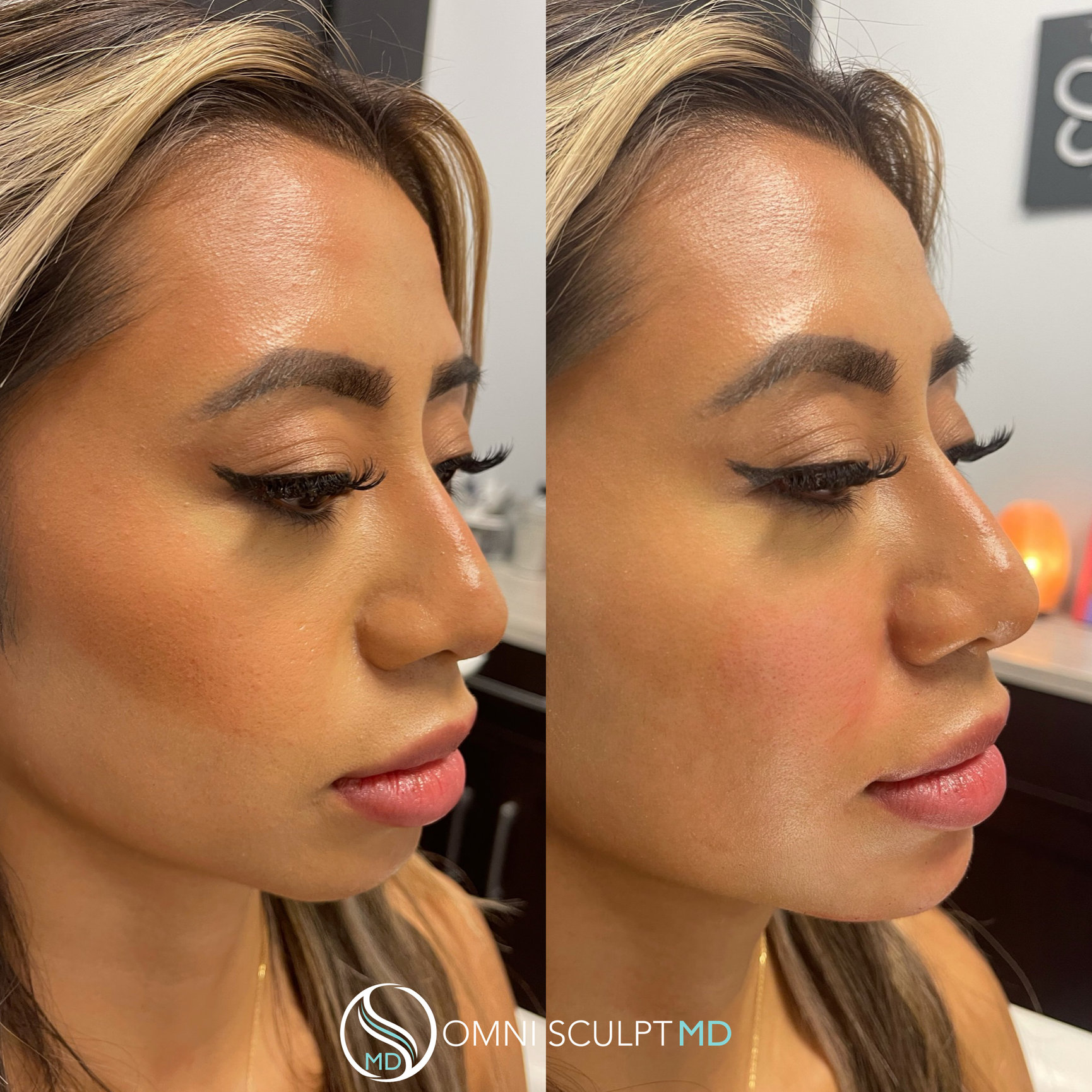 Chin and Jawline Filler in Dallas, TX OMNI SCULPT MD