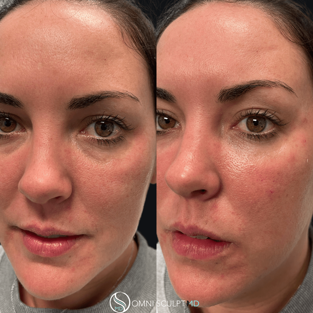 Under Eye Filler Before & After Gallery OMNI SCULPT MD