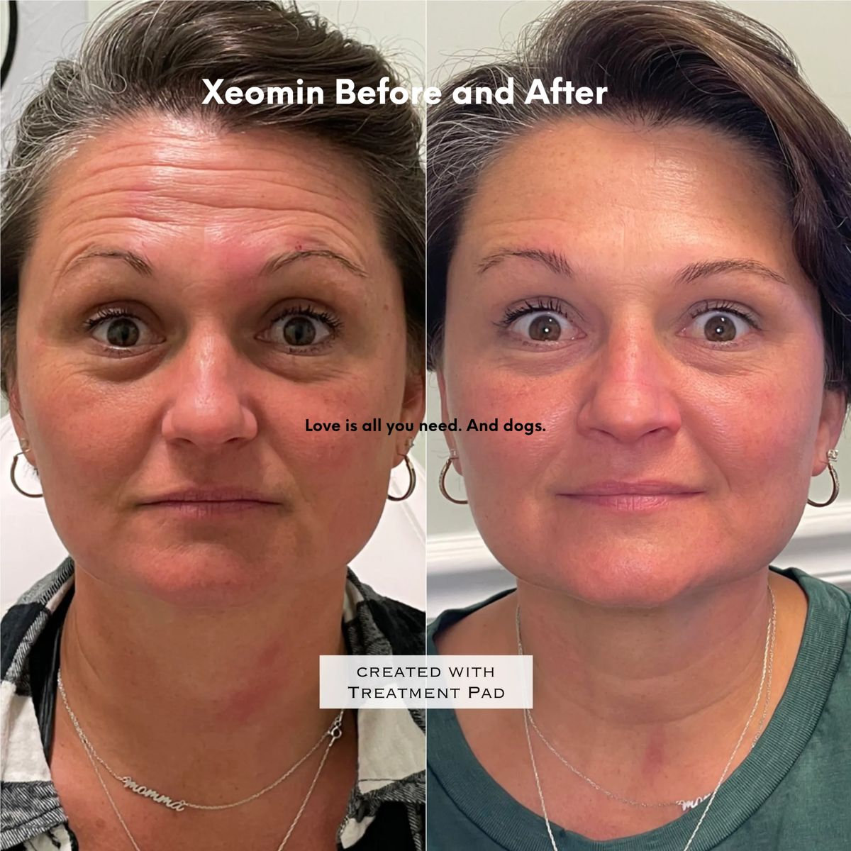 Botox Xeomin And Jeuveau Injections Brava Medspa