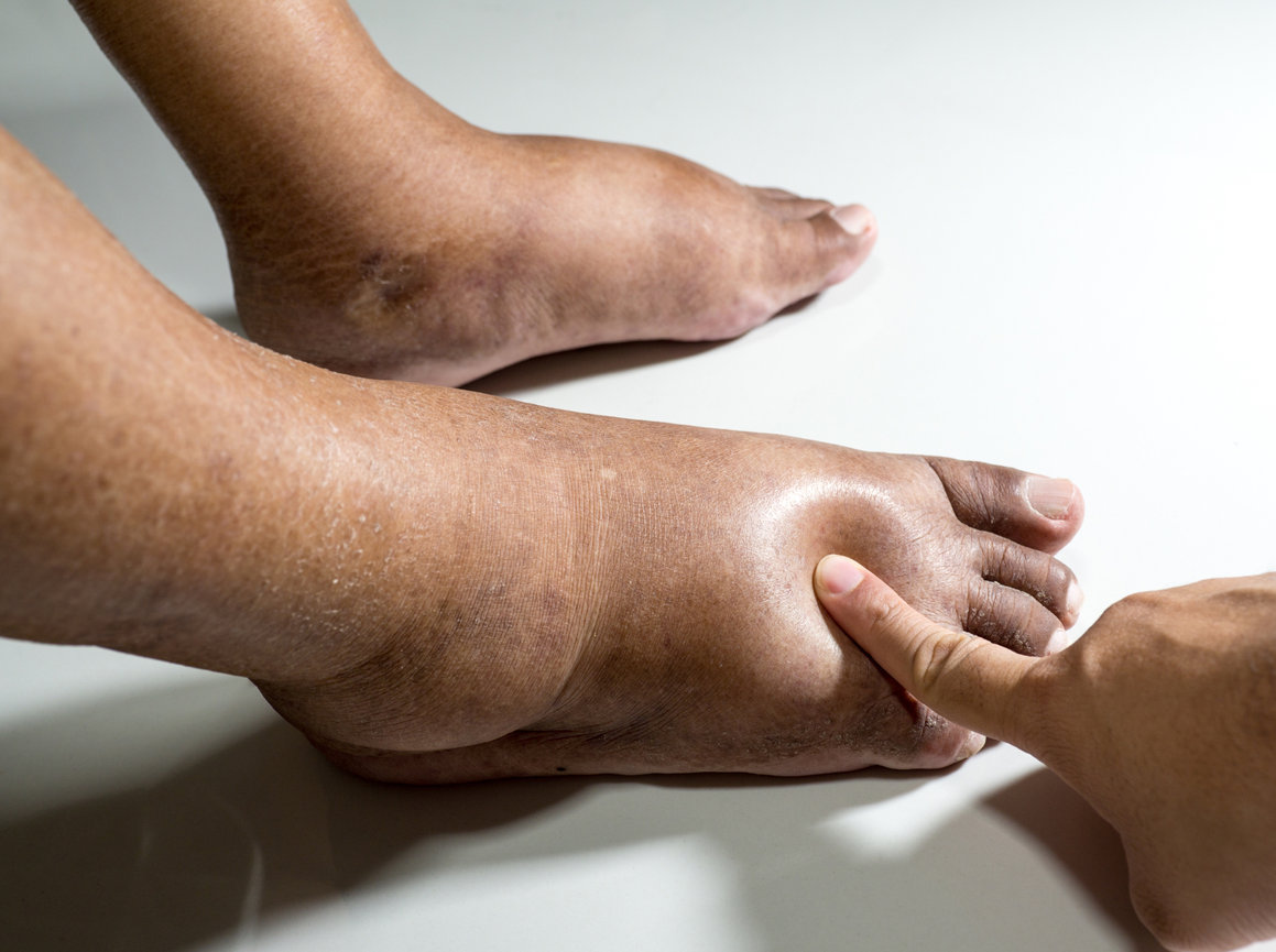 Diabetic Foot Care in Frisco, McKinney & Little Elm