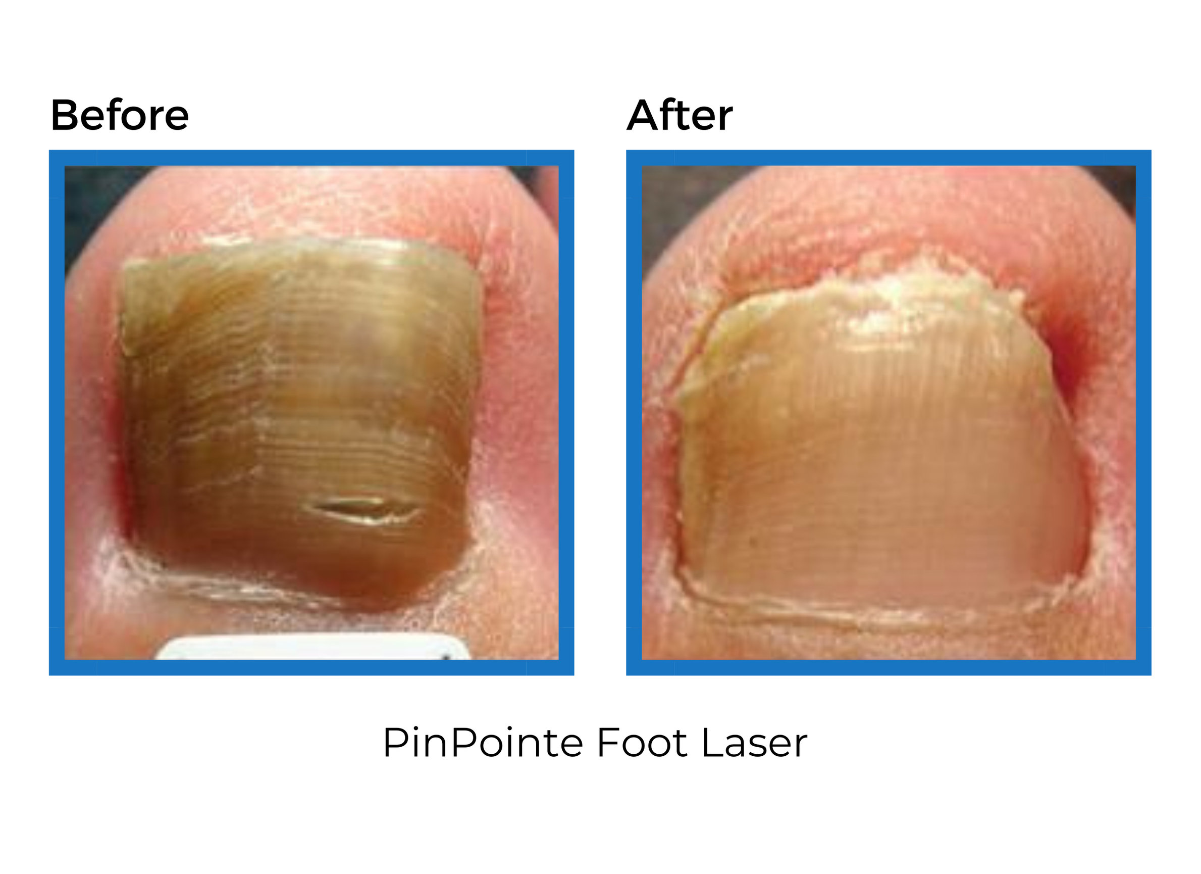Laser Fungal Nail Treatment Foot & Ankle Centers of Frisco and Plano