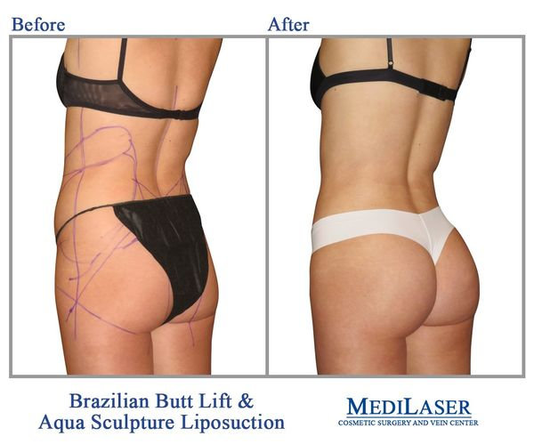 BBL-Brazilian-Butt-Lift-Before-And-After - Medilaser Surgery and Vein Center