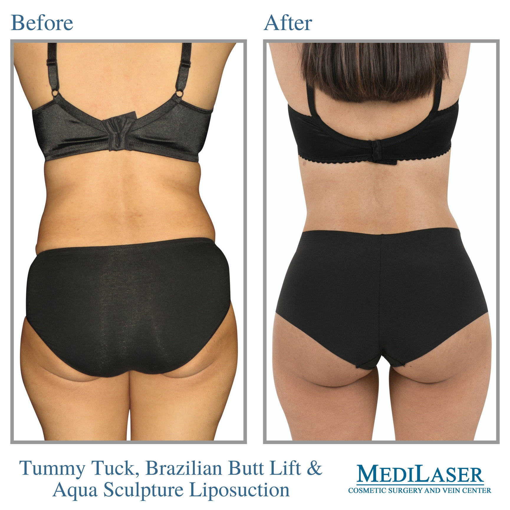 Aqua Sculpture Liposuction and Tummy Tuck Before and After - Medilaser  Surgery and Vein Center