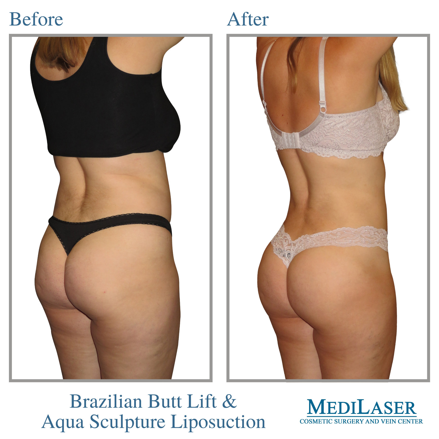 Tummy Tuck Before and After - Medilaser Surgery and Vein Center