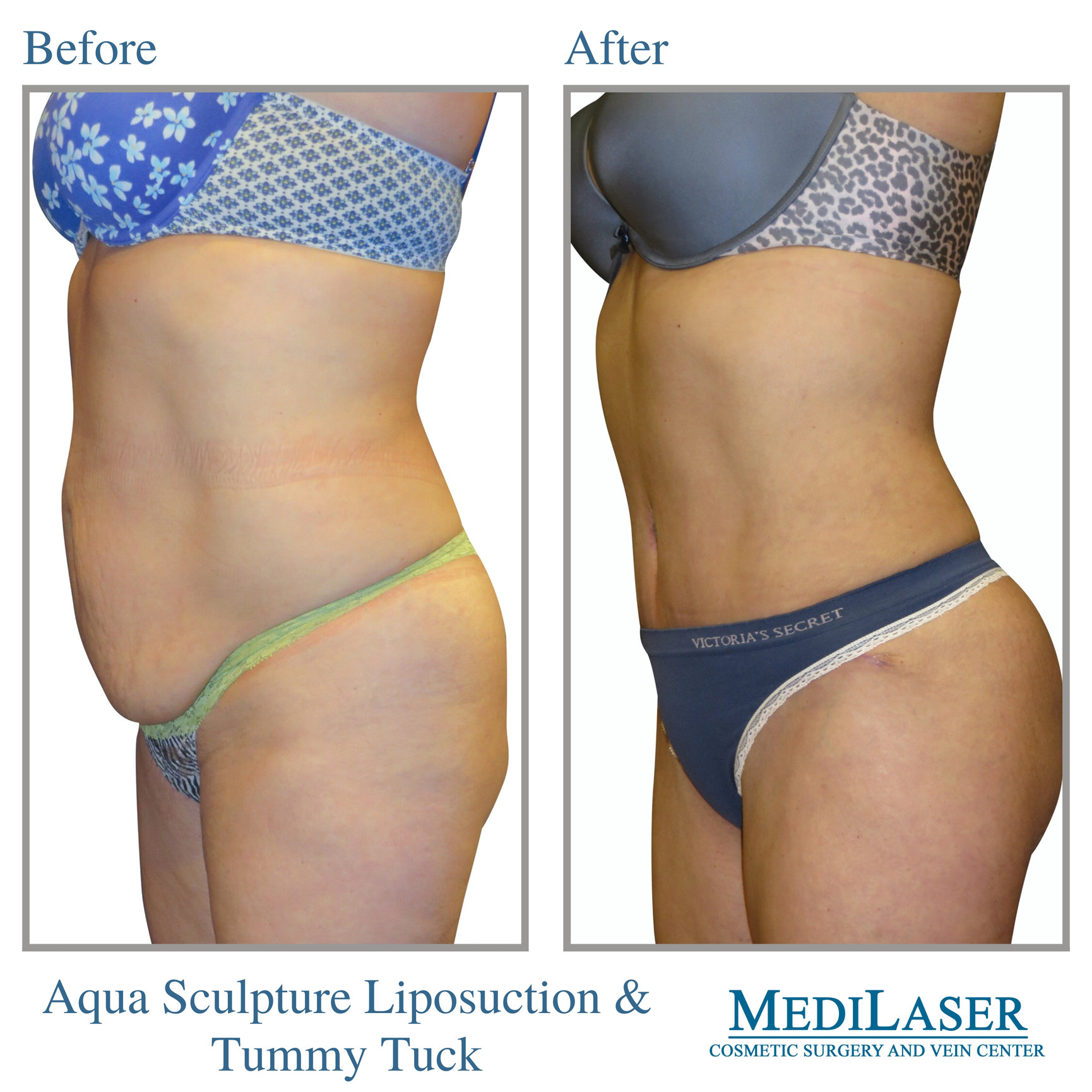 Tummy Tuck Liposuction Before and After - Medilaser Surgery and Vein Center